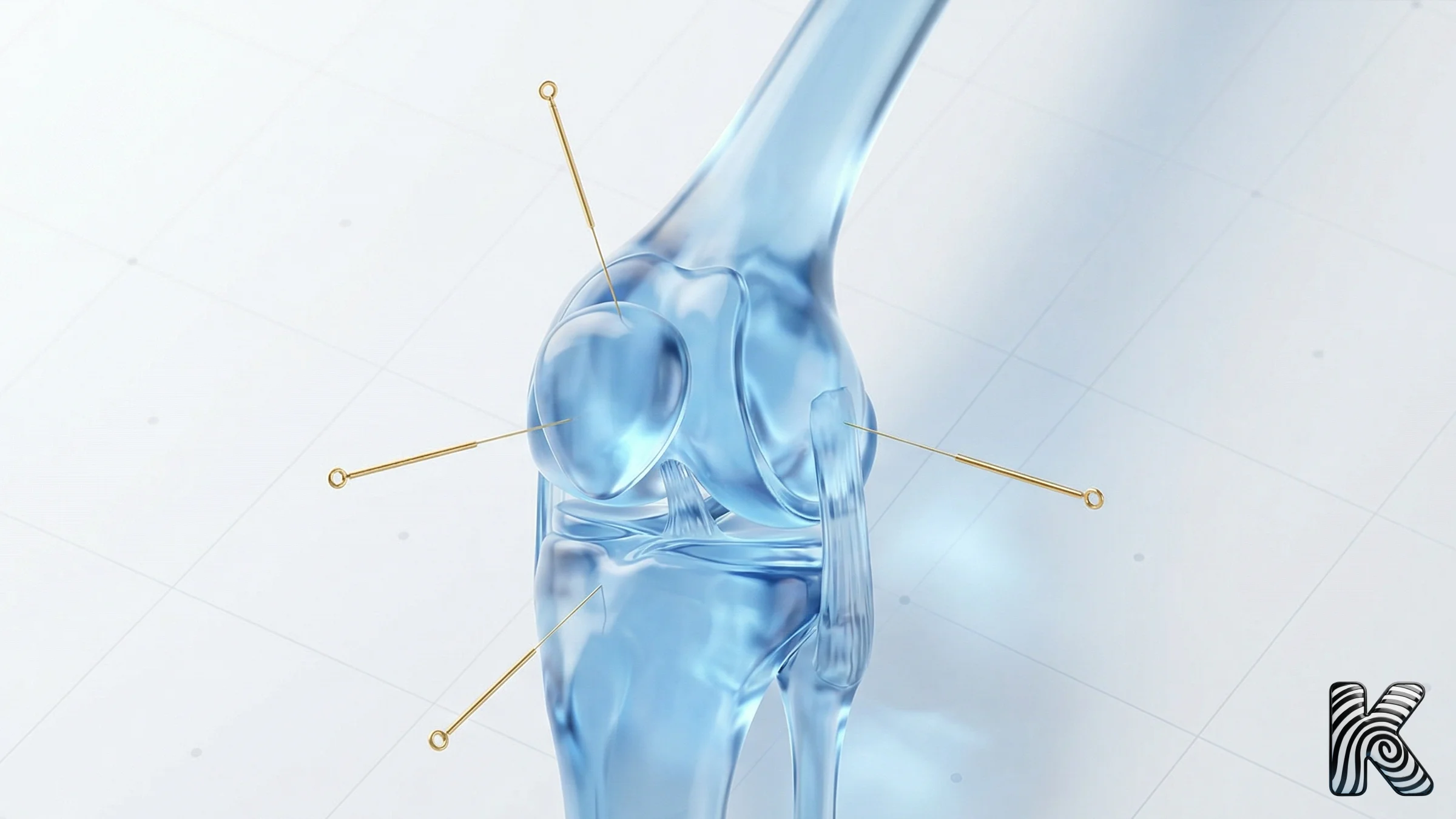 Acupuncture et genou arthrosique : des effets qui tiennent dans le temps ?